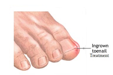 Ingrown toenail.jpg?1340218279138